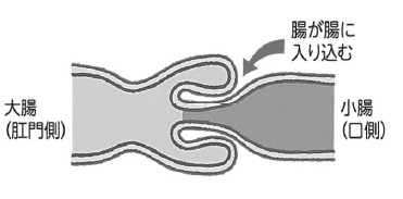 腸管に腸管が入り込み、腸が閉塞状態